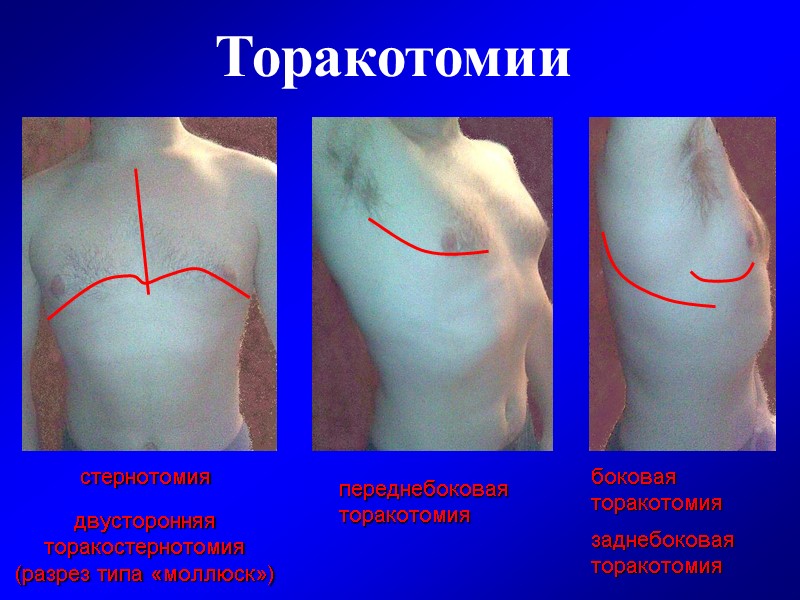 Торакотомии стернотомия двусторонняя торакостернотомия (разрез типа «моллюск») переднебоковая   торакотомия боковая  